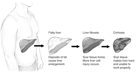 Stages of liver damage.
