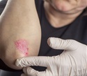 Breakthrough research identifies small peptide for psoriasis treatment