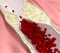 Novel nanomedicine mPEG@ELA-11 shows potential in treating atherosclerosis