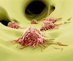 Study reveals a new oncogenic role of NBL1 in ovarian cancer metastasis