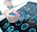 New study defines rapidly progressive dementia