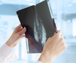 False-positive mammograms may indicate future breast cancer risk
