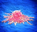 IASLC proposes new tumor budding-based grading system for lung squamous cell carcinoma