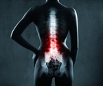 Using machine learning to better predict recovery after lumbar spine surgery