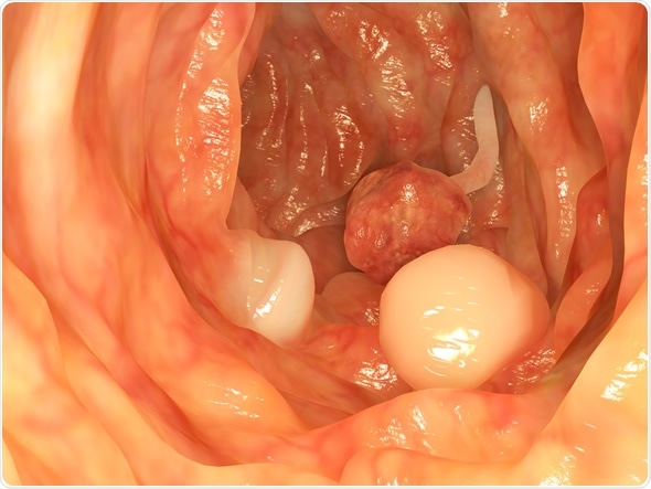 Intestinal polyps - Image Copyright: Juan Gaertner / Shutterstock