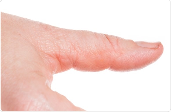 Spoon nail - Image Copyright: bmf-foto.de / Shutterstock