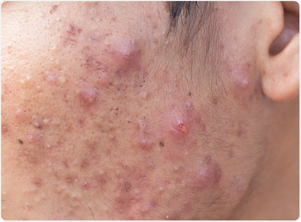Man with problematic skin and scars from acne (scar). Image Copyright: frank60 / Shutterstock Man with problematic skin and scars from acne (scar). Image Copyright: frank60 / Shutterstock