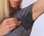 Hyperhidrosis Symptoms
