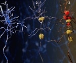 Study Identifies Predictors of Alzheimer's Disease Longevity