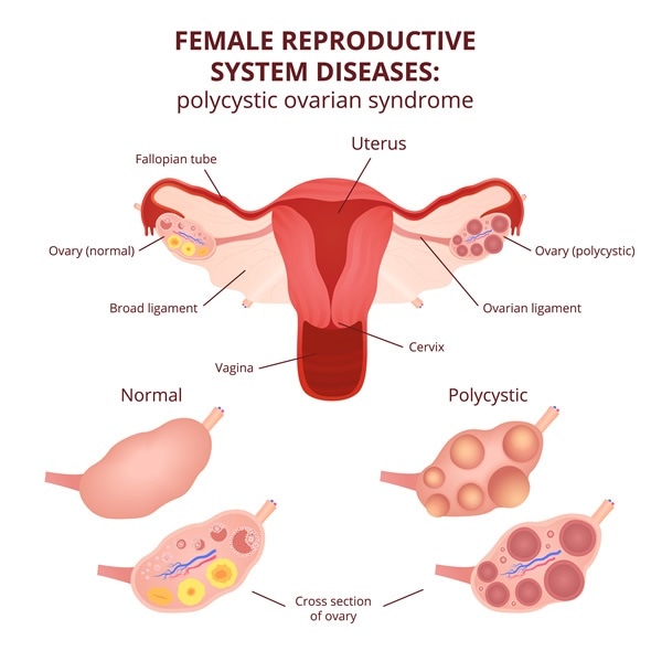 Female reproductive system, the uterus and ovaries scheme, polycystic ovary syndrome, ovarian cyst - Image Copyright: Marochkina Anastasiia / Shutterstock
