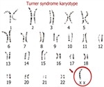 Turner Syndrome Signs and Symptoms
