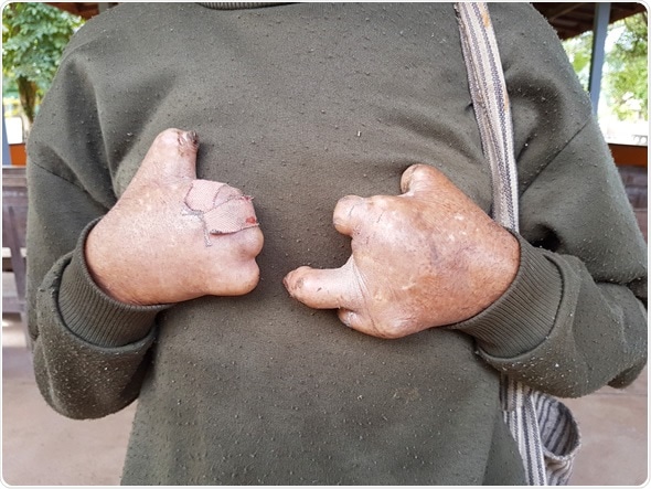 Closeup hands of asian old man suffering from leprosy, Thailand - Image Credit: Bidarat Tiemjai / Shutterstock Closeup hands of asian old man suffering from leprosy, Thailand - Image Credit: Bidarat Tiemjai / Shutterstock