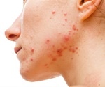 Acne may be a natural, transient inflammatory state when facial skin is exposed to microbes