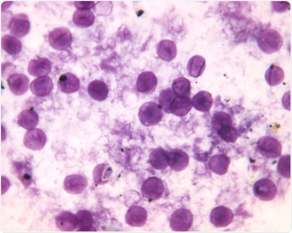 Smear of Pneumocystis jirovecii, formerly known as Pneumocystis carinii, concentrated from human lung. Toluidine blue stain. Cysts of Pneumocystis jirovecii, concentrated from human lung. Toluidine blue stain. Image Credit: CDC