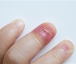 What are Nail Fold Infections (Paronychia)?