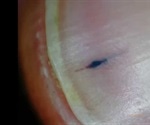 Splinter Hemorrhages