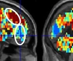 Suicidal individuals could be identified using brain scans