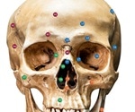 Zygomatic Fractures