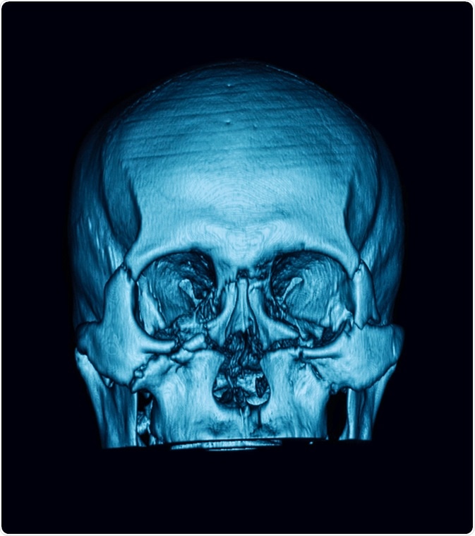 Computed tomography (3DCT scan) of facial bone, showing multiple maxillofacial fractures. Image Credit: Suttha Burawonk /Shutterstock