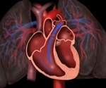 Patent Ductus Arteriosus (PDA) Overview