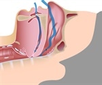Obstructive Sleep Apnea in Children
