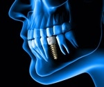 New technology to improve dental implant bridges receives US patent