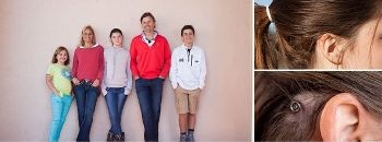 Cochlear's Baha Connect System with Minimally Invasive DermaLock Technology