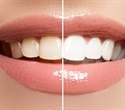 Uneven tooth color matters more than whiteness for young adults