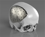 Renishaw to present latest developments in craniomaxillofacial implants at BAOMS