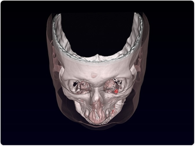 Magnetic Oculomotor Prosthetics for Acquired Nystagmus - Prosthesis shown in red. Image Credit: Dr Parashkev Nachev