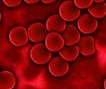 Discovery of novel cause of iron overload in patients with thalassemia