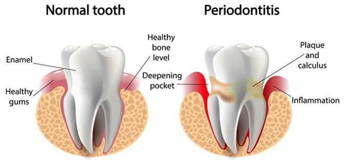 Periodontitis - Image Credit: Elen Bushe / Shutterstock
