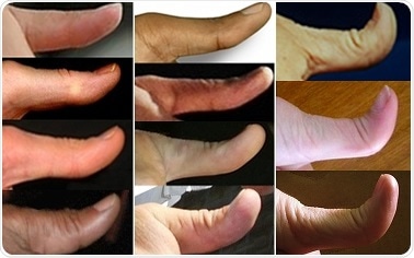 Thumbs ranging from straight to hitchhiker. Image Credit: Myths of Human GeneticsJohn H. McDonald, University of Delaware Thumbs ranging from straight to hitchhiker. Image Credit: Myths of Human GeneticsJohn H. McDonald, University of Delaware