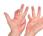Dupuytren's Contracture (Palmar Fibromatosis)