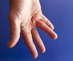 Dupuytren's Contracture Genetics