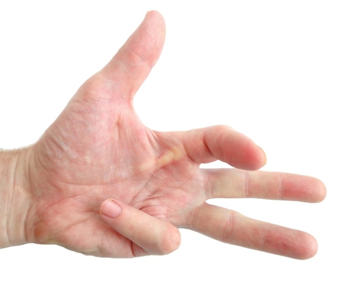 Hand of an man with contracture Dupuytren. Image Credit: Sokolenok / Shutterstock