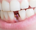 Dental Implant Risks