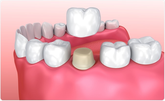 Dental crown installation process. Image Credit: Alex Mit / Shutterstock