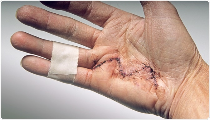 Hand surgery done to alleviate Dupuytren