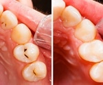 Dental Filling Procedure