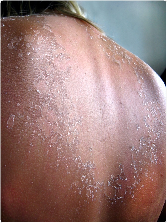 Burn from the sun - sun damage. Image Credit: alexmak7 / Shutterstock