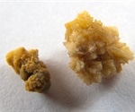 Kidney Stones in Children