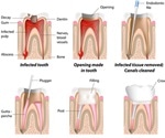 Root Canal Treatment Procedure