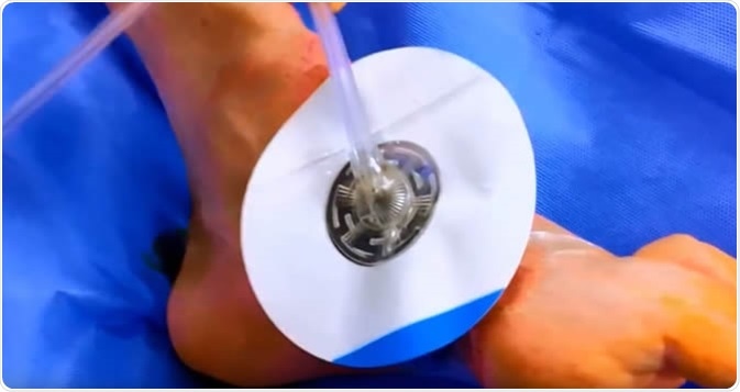 Topical Negative Pressure Wound Therapy, VAC