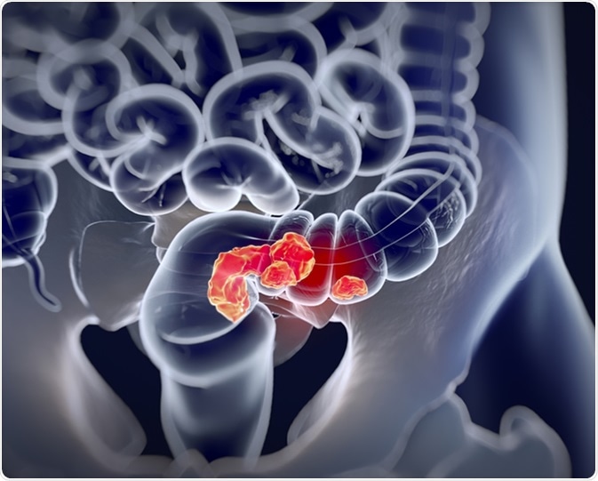 Colorectal cancer. Image Credit: Anatomy Insider / Shutterstock