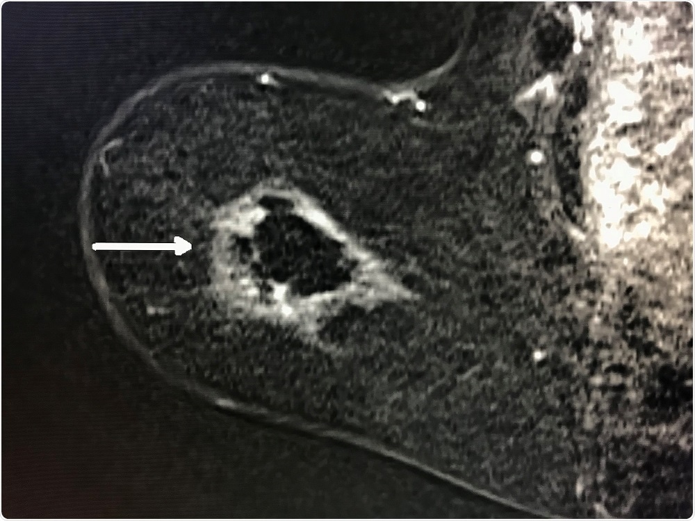 Breast cancer cells targeted in cyroablation - Radiological Society of North America