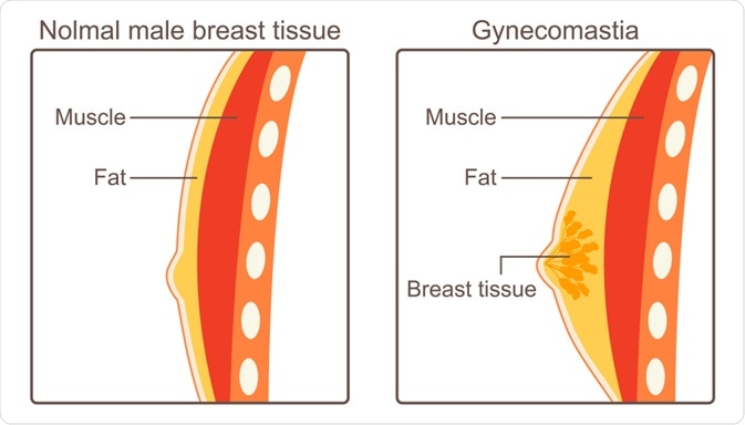 Diagram of gynecomastia - By CHEN I CHUN