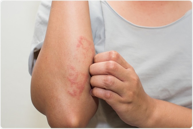 Eczema. Image Credit: Pumatokoh