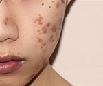 Hyperpigmentation and Acne