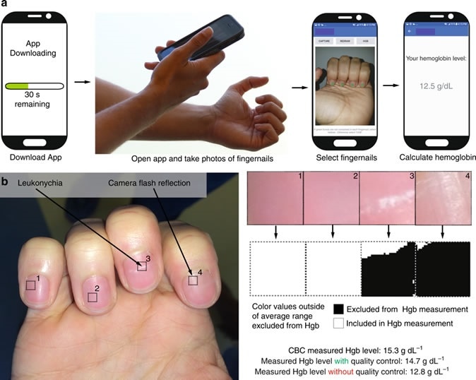 Implementation of a smartphone app for measuring hemoglobin (Hgb). a A patient simply downloads the app onto their smartphone, opens the app, obtains a smartphone photo of his/her fingernail beds, and without the need for any blood sampling or additional smartphone attachments or external calibration tools, quantitatively measures blood Hgb levels. The patient first takes an image of their fingernails, and is then prompted by the app to tap on the screen to select the regions of interest corresponding to the nailbeds, and a result is then displayed on the smartphone screen. Images are screenshots and photos of actual operation of this app. b As smartphone images with fingernail irregularities such as camera flash reflections or leukonychia may affect Hgb level measurements, a quality control algorithm integrated within the Hgb level measurement app detects and omits those irregularities to preserve measurement integrity and accuracy.